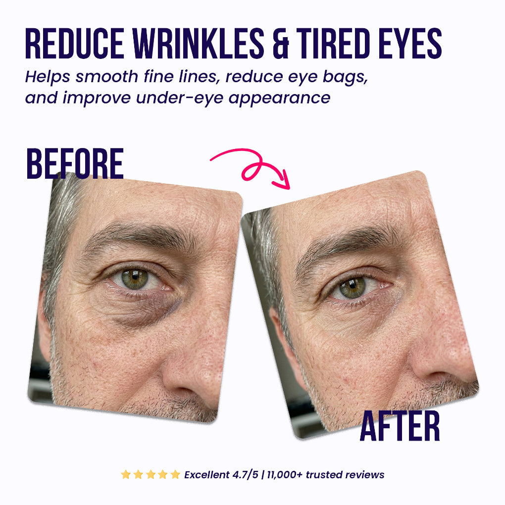 Tervelle™ Under-Eye Repair Patches
